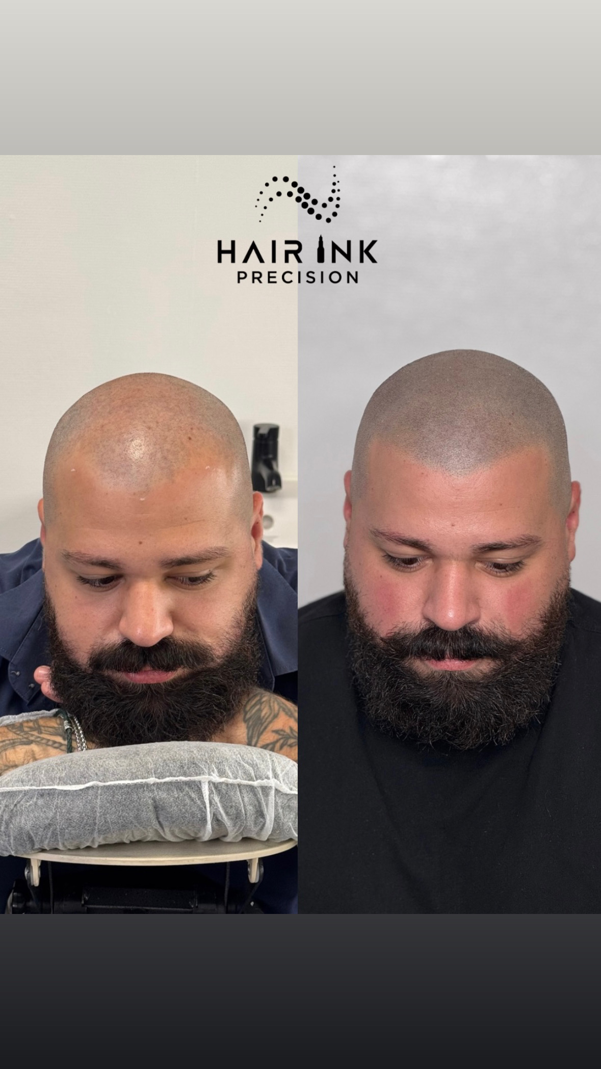 Résultat tricopigmentation