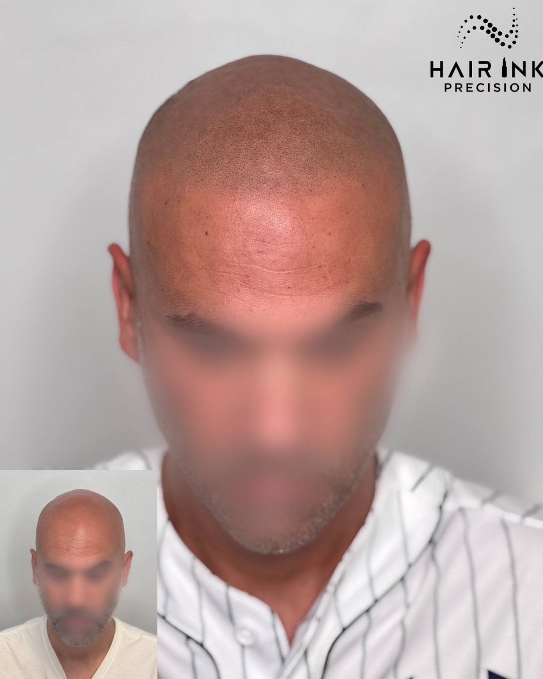 Résultat tricopigmentation