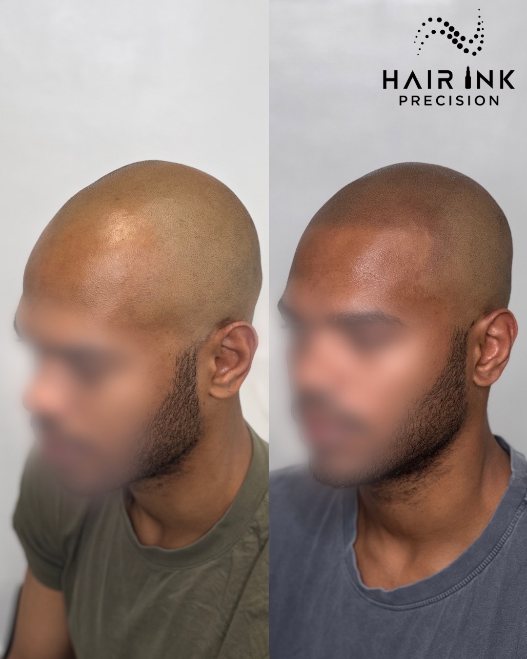 Résultat tricopigmentation