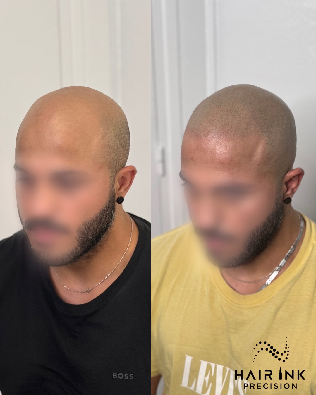 Résultat tricopigmentation