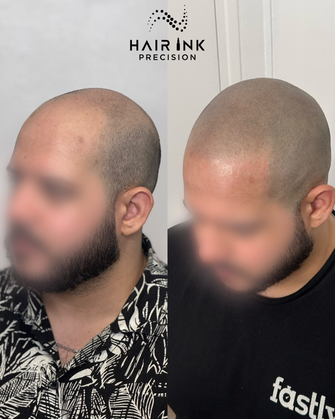 Résultat tricopigmentation