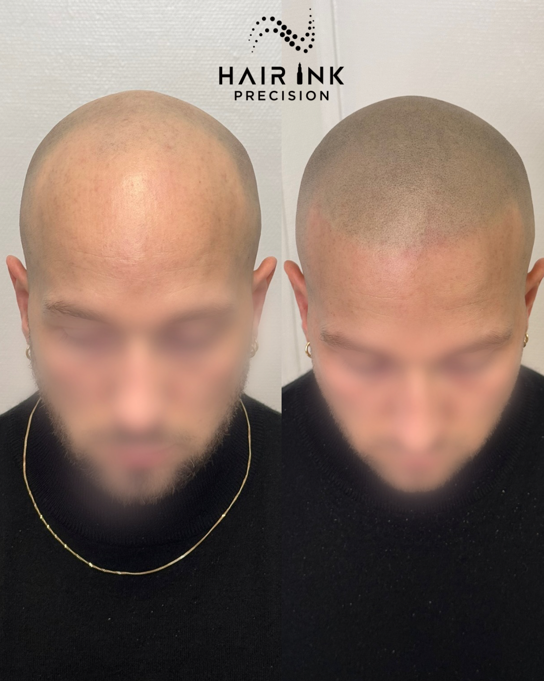 Résultat tricopigmentation